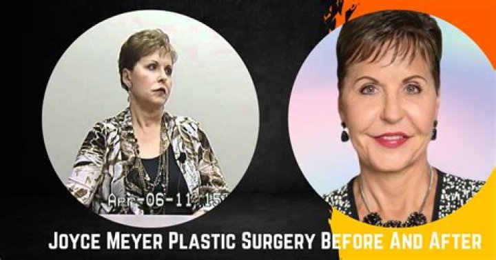 Joyce Meyer's Plastic Surgery Journey