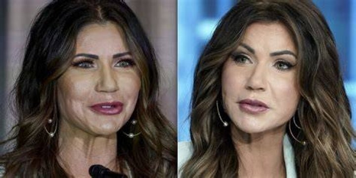 Kristi Noem's Cosmetic Surgery Journey