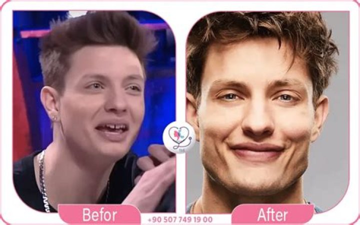 Unveiling The Secrets Of "Matt Rife Before And After Surgery": A Journey Of Transformation